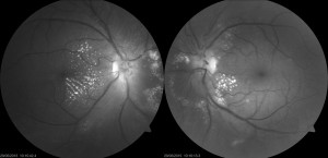 IRVAN Syndrome (idiopathic retinitis, vasculitis, aneurysm and neuro ...